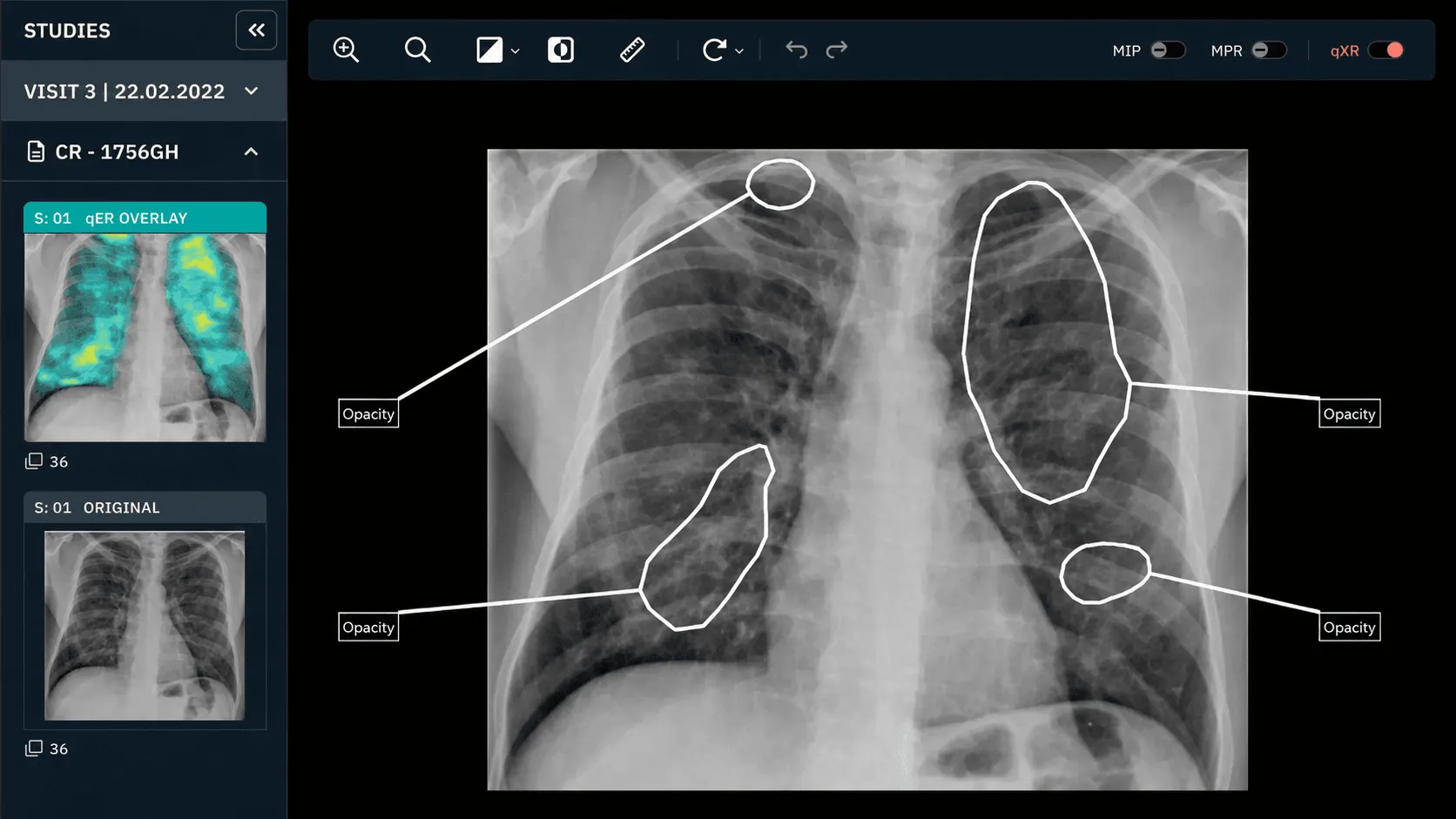 Qure.ai diagnostic scan interface with AI overlay - Impulse Digital Marketing Case Study